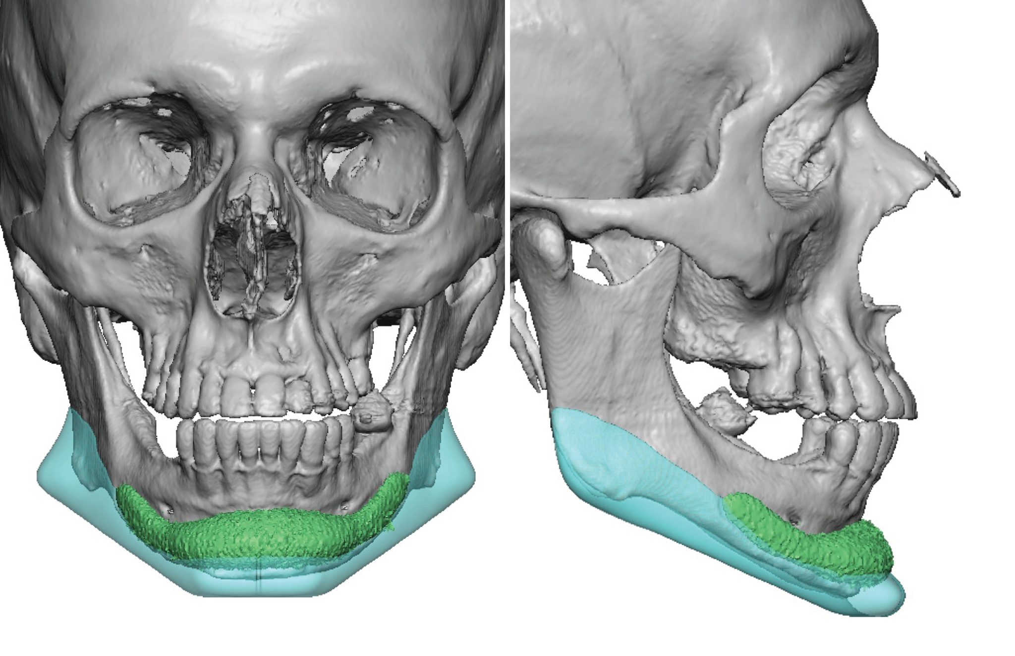 Plastic Surgery Case Study - Custom Jawline Implant Replacement of ...