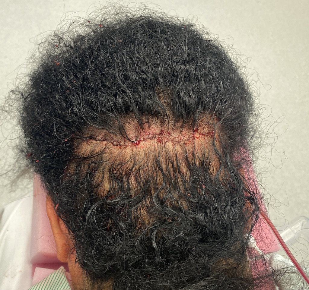 Female Custom Skull Implant Scalp Closure Explore Plastic Surgery