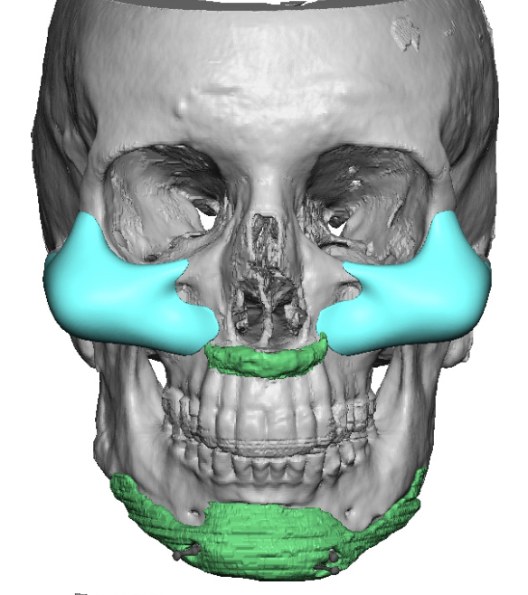 large female custom cheek implant designs front view Dr Barry Eppley ...