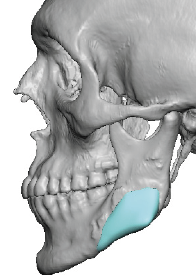 Plastic Surgery Case Study - Standard Jaw Angle Implant and Bone ...