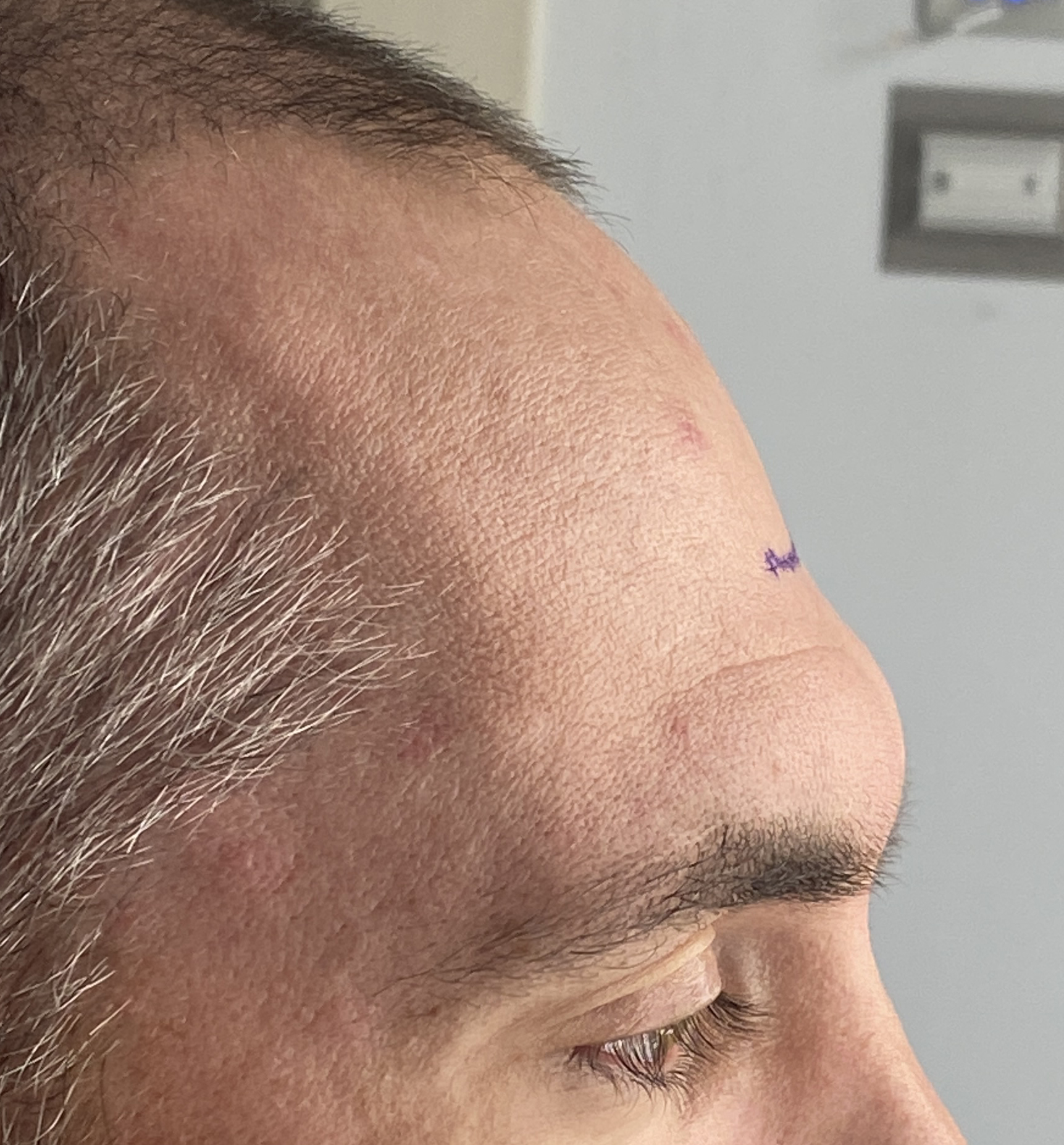 Plastic Surgery Case Study - The Male Mid-Forehead Approach To Brow ...