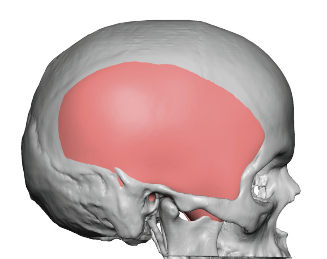 Male Custom Skull Implant Anbd Forehead Reduction Dr Barry Eppley