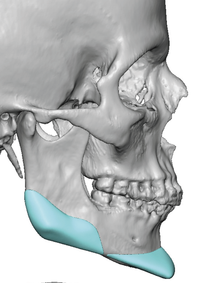 male custom square chin and jaw angle implants design side view Dr ...