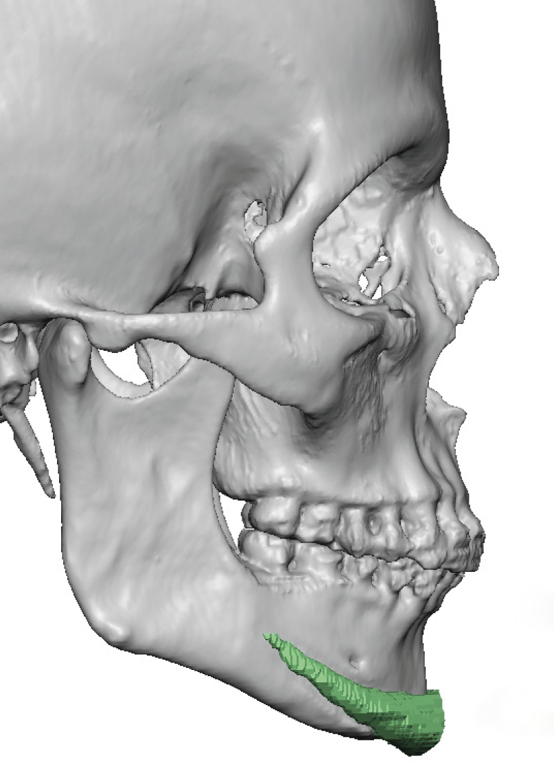 male squae chin implant 3D CT scan side view Dr Barry Eppley - Explore ...