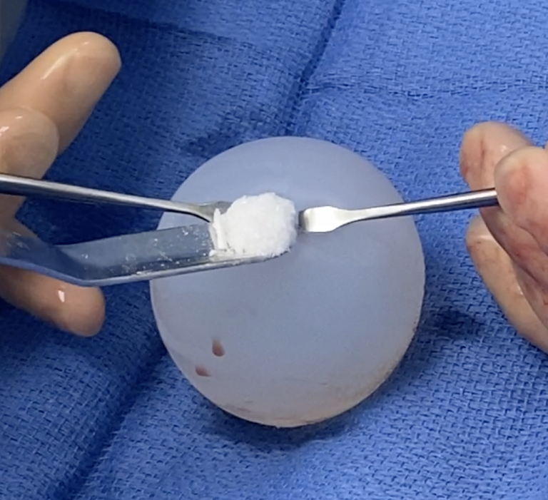 Plastic Surgery Case Study Remove and Replace Custom Testicle