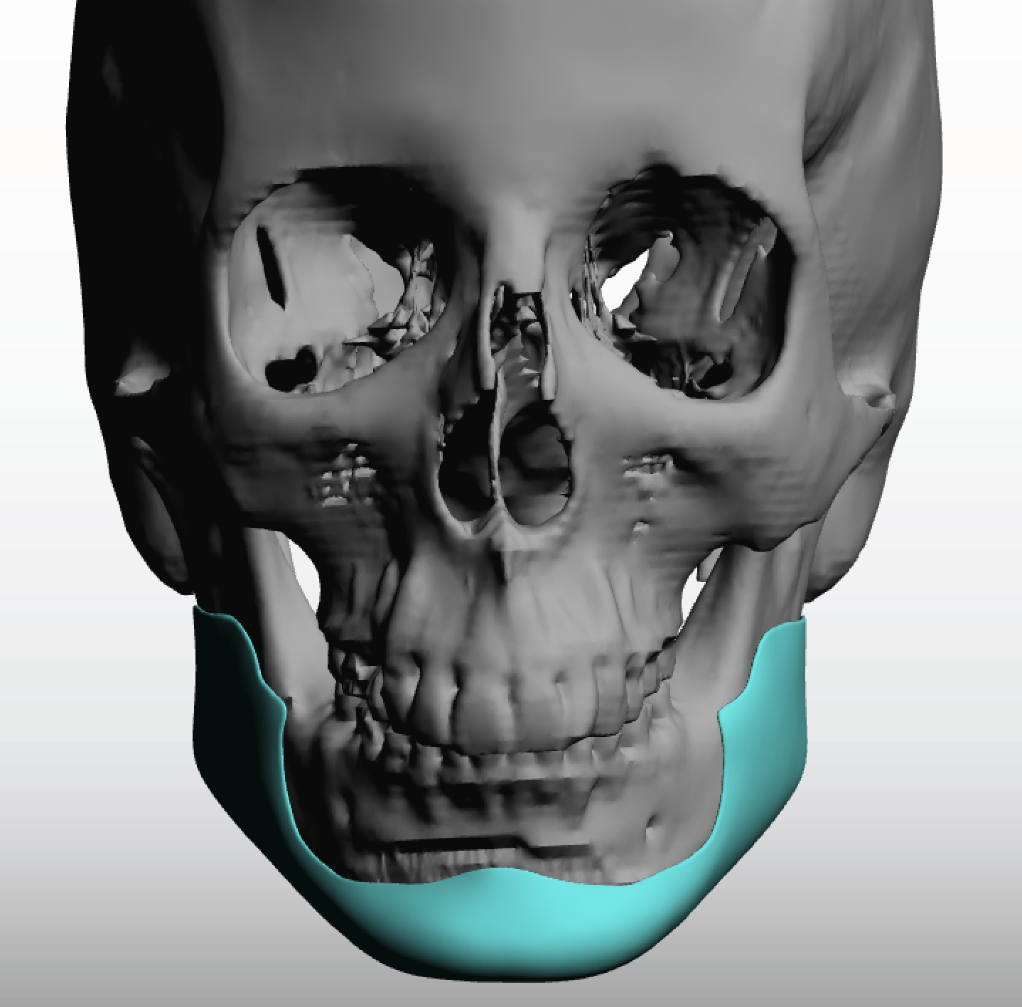 Female Custom Jawline Implant 3d Design Front View Dr Barry Eppley 