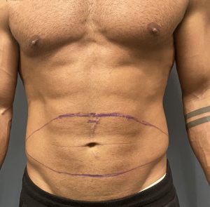 Case Study: Tummy Tuck for the Clefted Abdominal Pannus in a Hispanic  Female - Explore Plastic Surgery