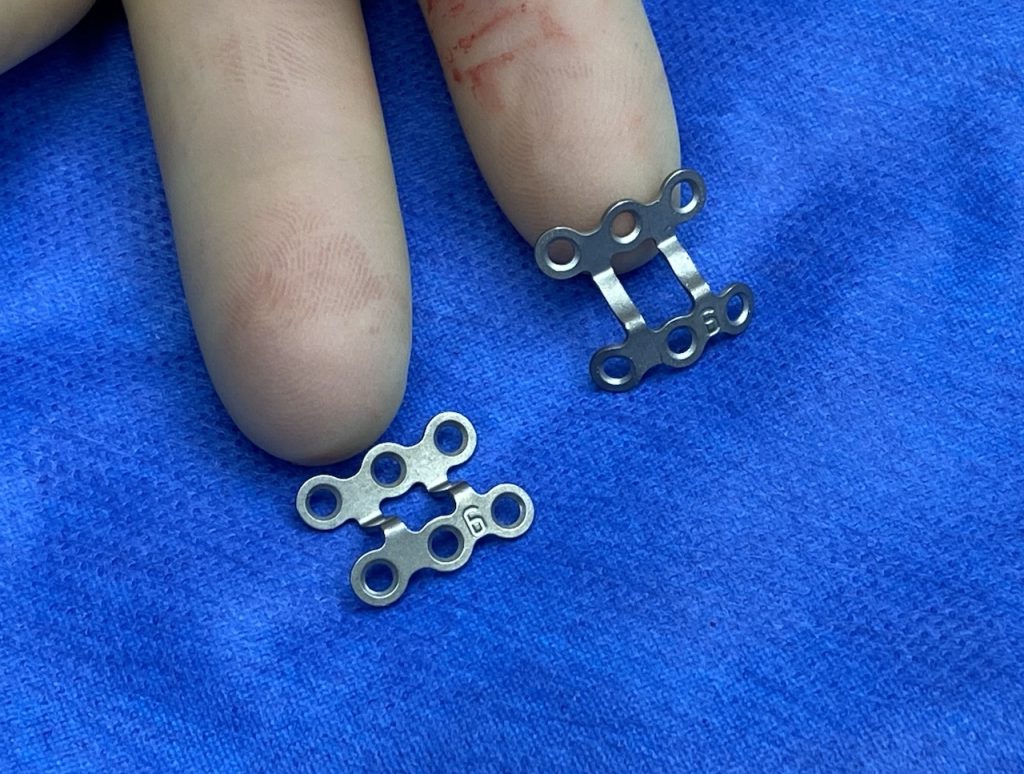 Plastic Surgery Case Study Combined Horizontal and Vertical (45