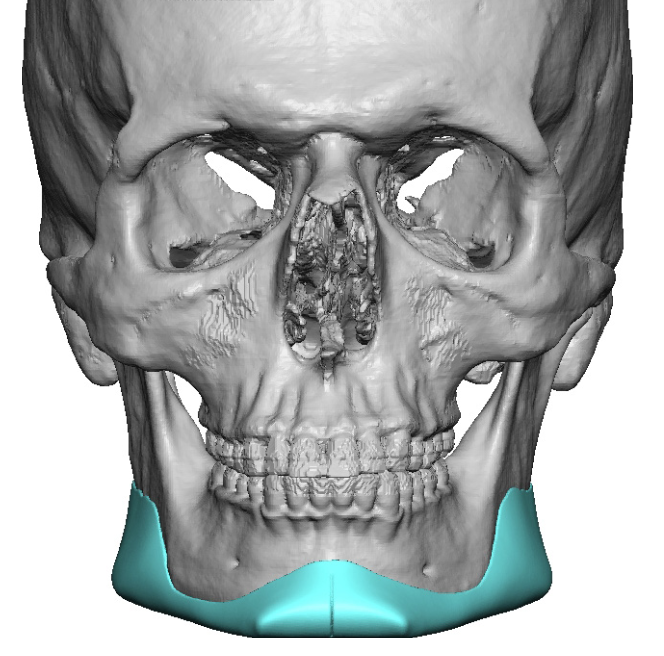 custom jawline implant design front view Dr Barry Eppley - Explore ...