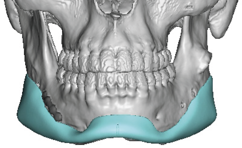 Technical Strategies - The Two Piece Split in Custom Jawline Implant ...