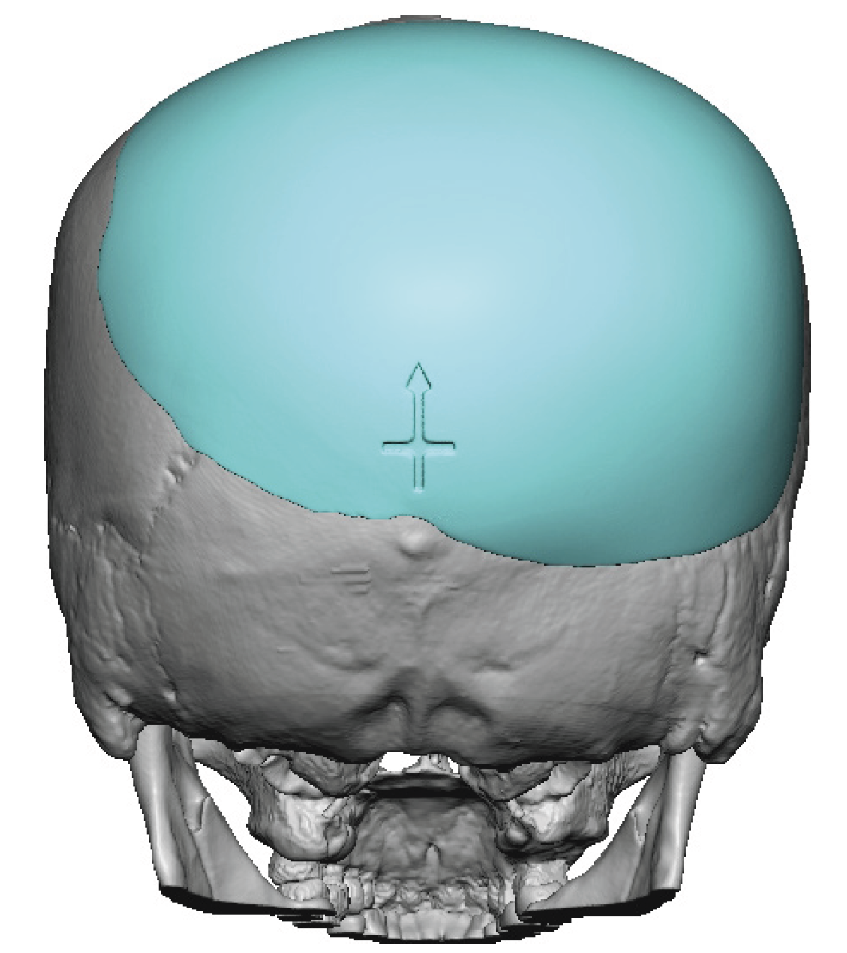 Custom Skull Implant Design For Plagiocephaly Back View Dr Barry Eppley