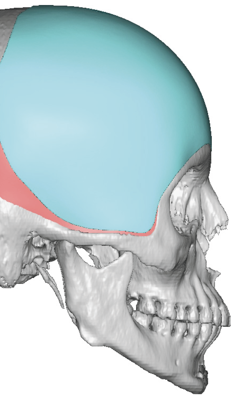 female custom forehead-temporal implant design side view Dr Barry ...