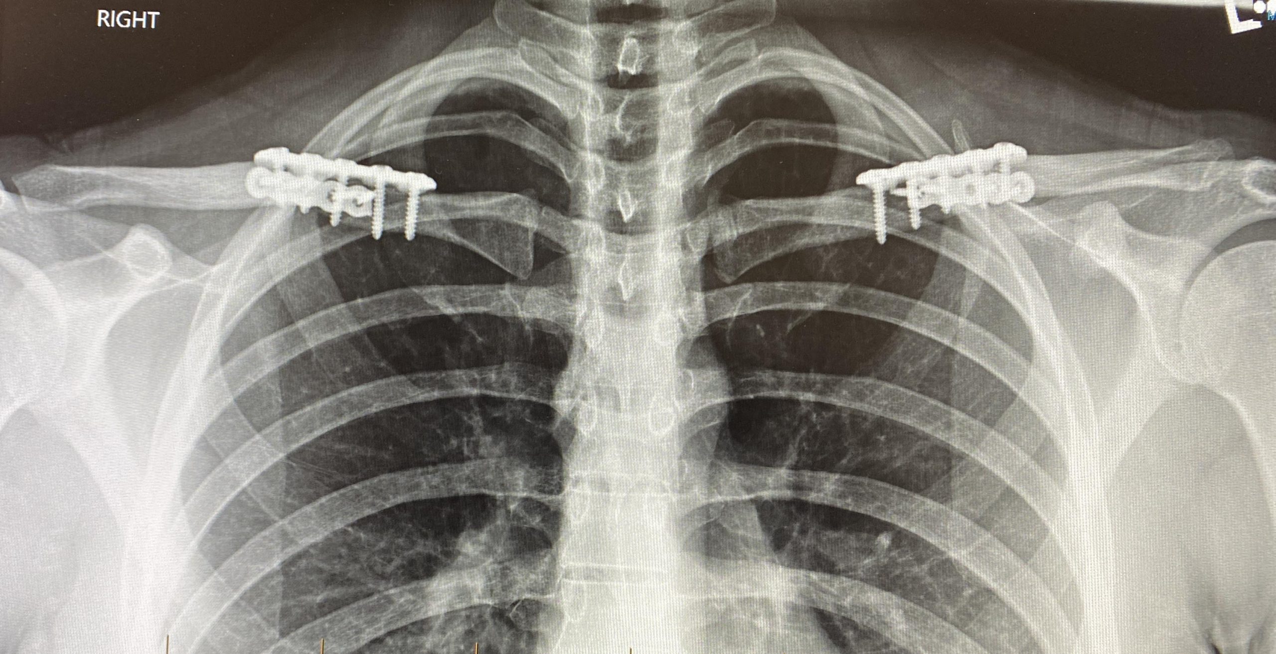 female shoulder reduction postop xray Explore Plastic Surgery