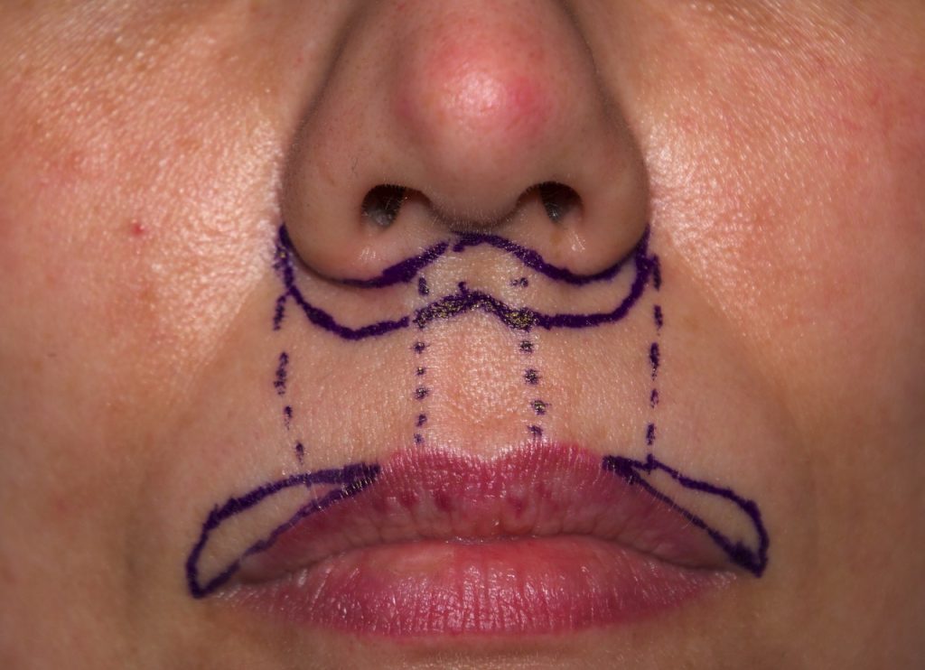 female-subnasal-lip-lift-and-lateral-vermilion-advancement-markings-dr