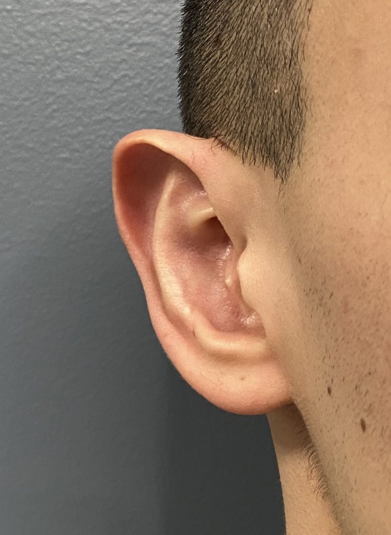 Technical Strategies - Dermal Graft Helical Rim Ear Contouring ...