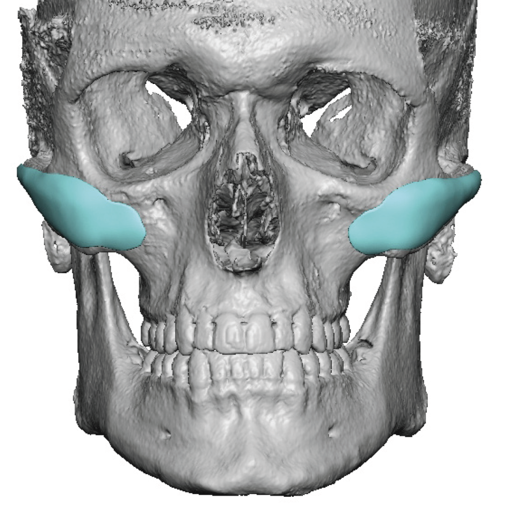 Plastic Surgery Case Study - Achieving An Improved Cheek Implant ...