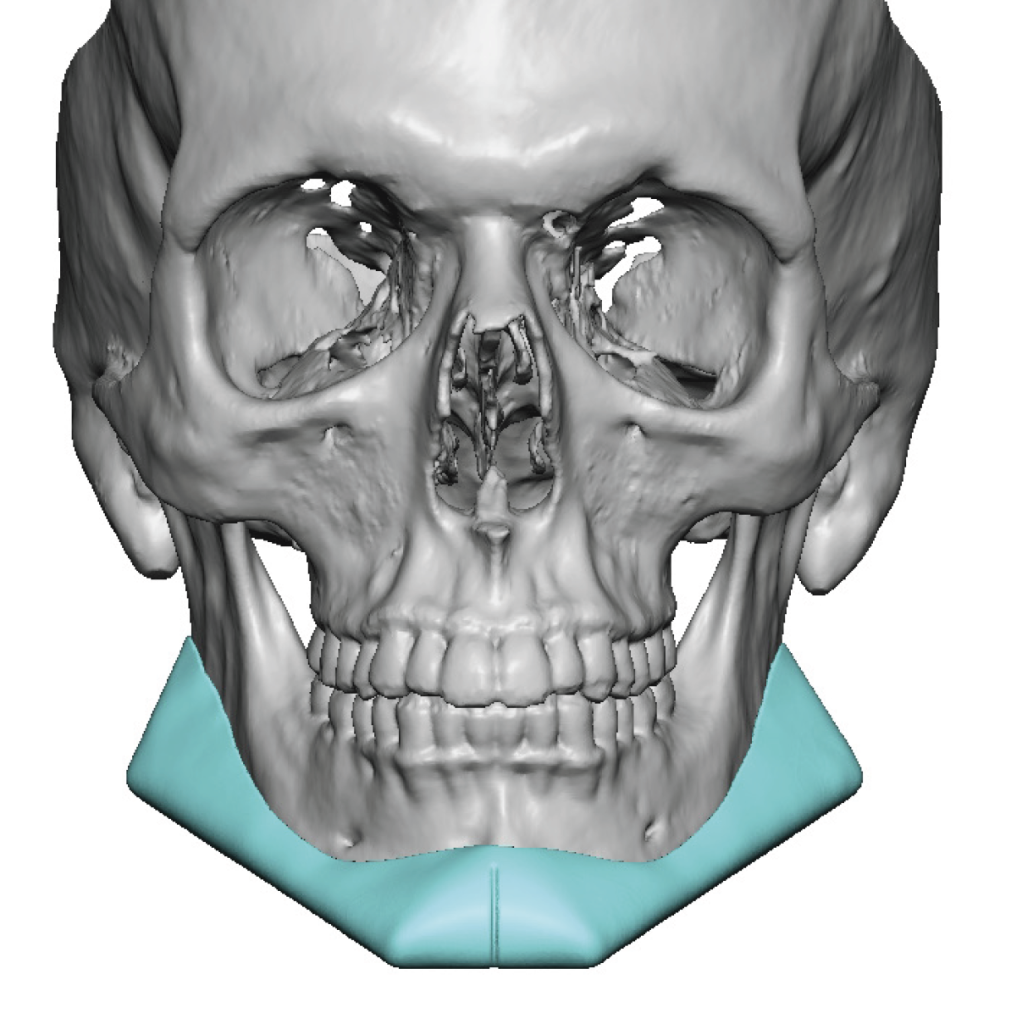 Male Jawline Design Front View Dr Barry Eppley - Explore Plastic Surgery