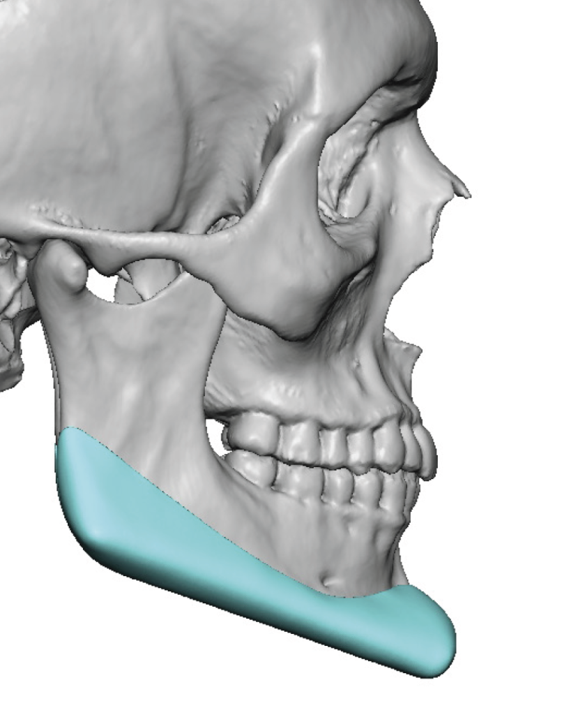 Plastic Surgery Case Study - Male Custom Jawline Implant Design And 