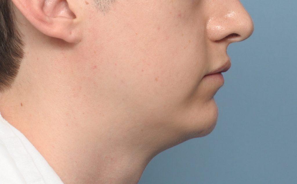 Plastic Surgery Case Study Male Custom Jawline Implant Design and