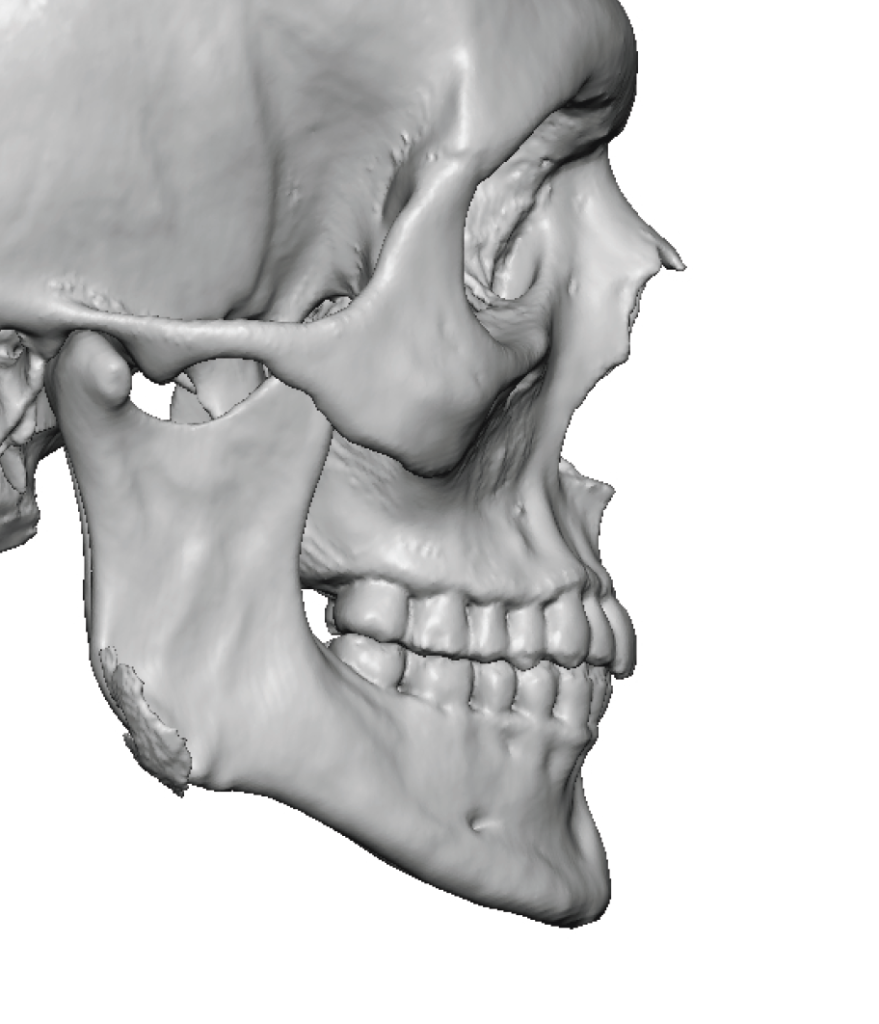 Plastic Surgery Case Study - Male Custom Jawline Implant Design and ...