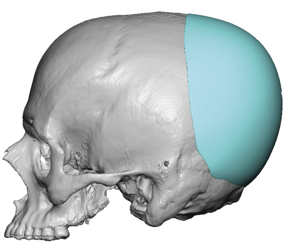 Plastic Surgery Case Study Two Stage Male Back Of Head Skull Implant