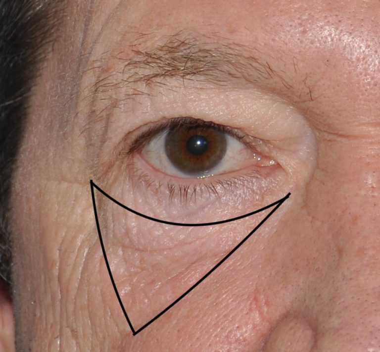 Technical Strategies MiniIncision Direct Festoon Access