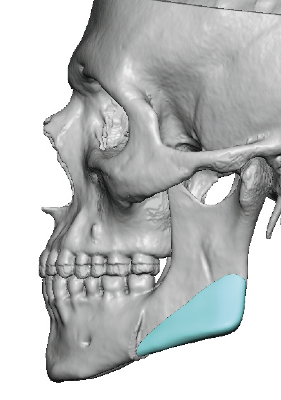 Plastic Surgery Case Study - Custom Jaw Angle Implant Replacements for ...