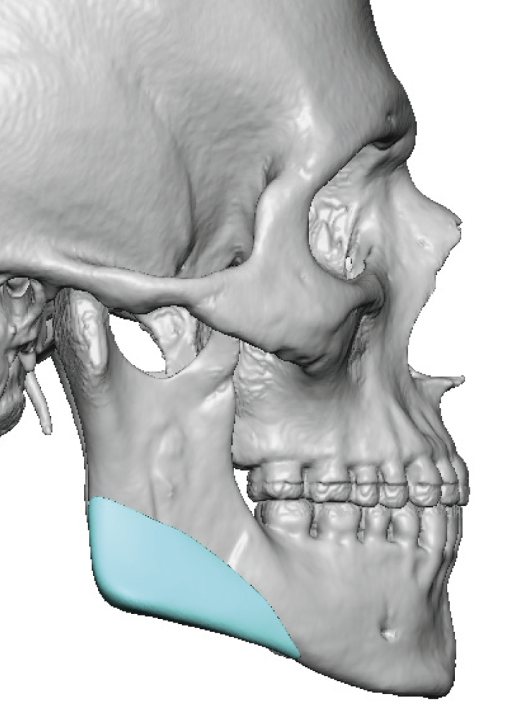 Plastic Surgery Case Study Custom Jaw Angle Implant Replacements for