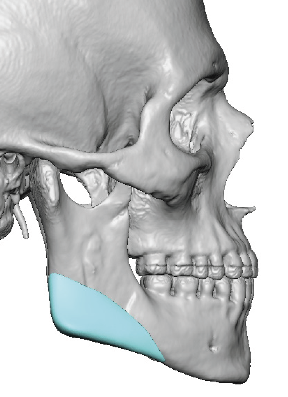 Plastic Surgery Case Study - Custom Jaw Angle Implant Replacements for ...