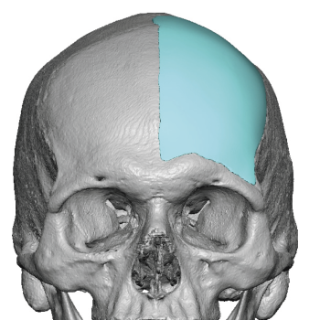 forehead recontouring Archives - Explore Plastic Surgery