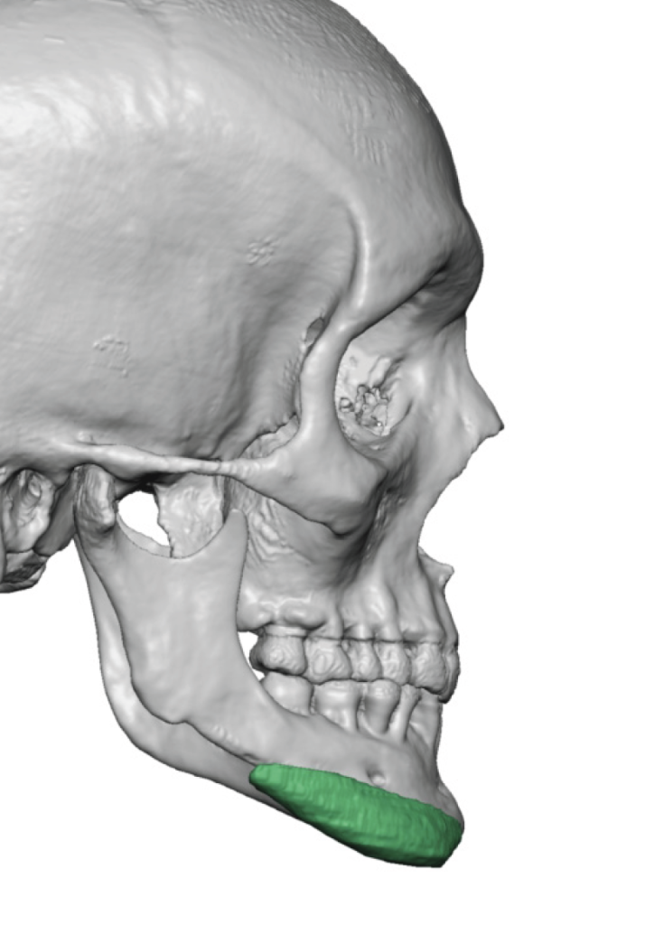 Plastic Surgery Case Study - Custom MIdface and Jawline Implants in ...