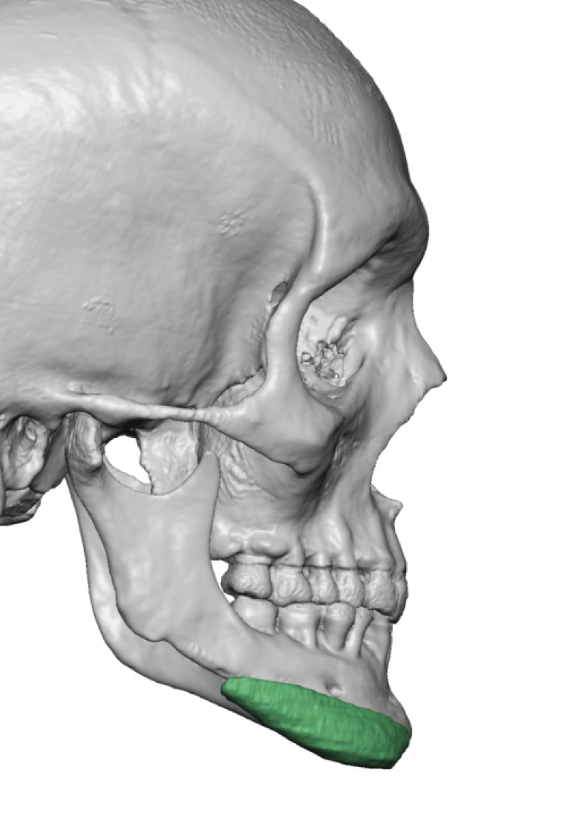 facial asymmetry 3D Ct scan side view Dr Barry Eppley - Explore Plastic ...