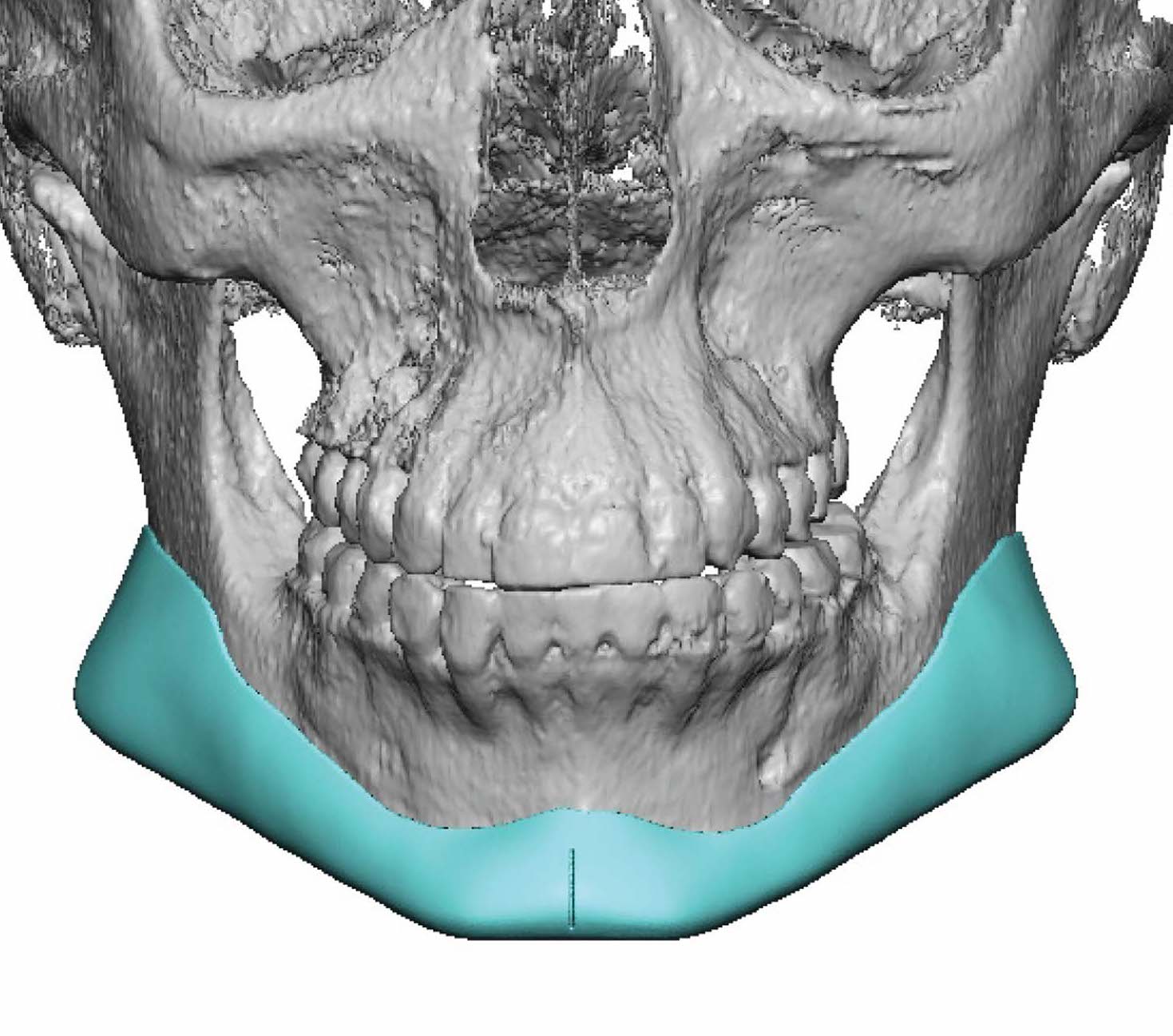 female custom jawline implant design front view Df Barry Eppley 2 ...