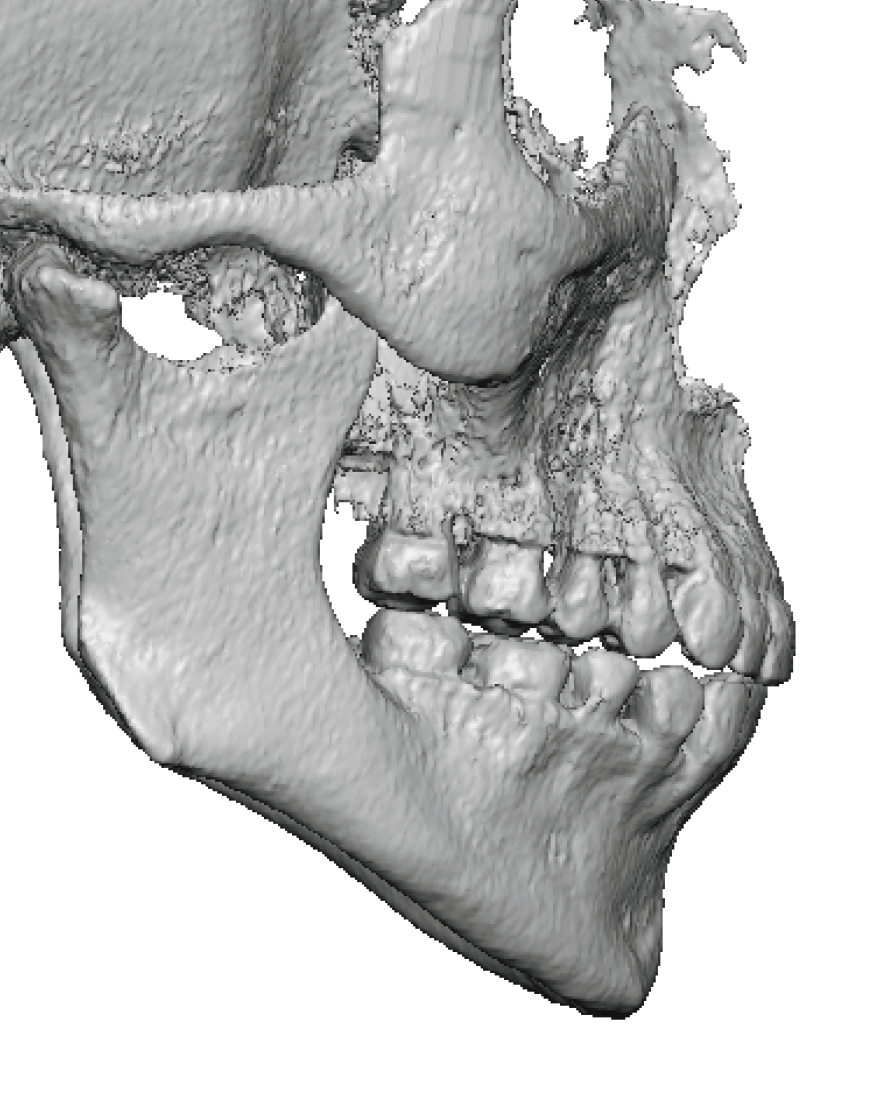 female left jaw angle anatomy 3D Ct scan right side Dr Barry Eppley ...