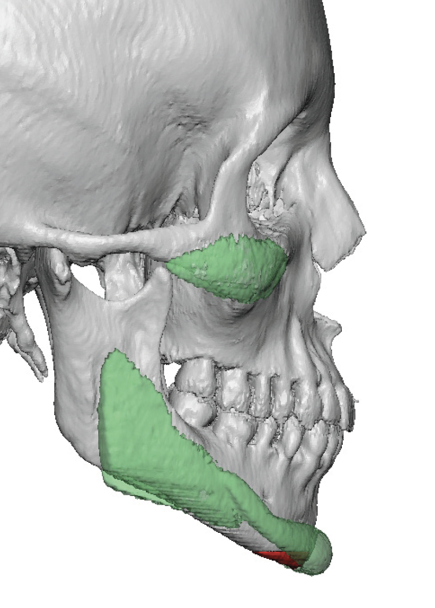 female standard cheek chin and jaw angle implanys side view 3D CT scan ...