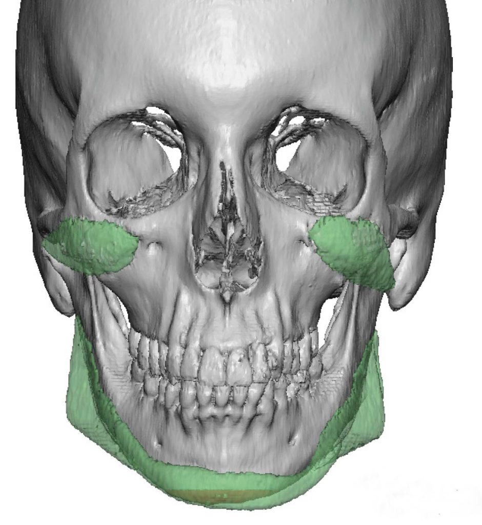 Plastic Surgery Case Study - Female Facial Feminization with Custom ...