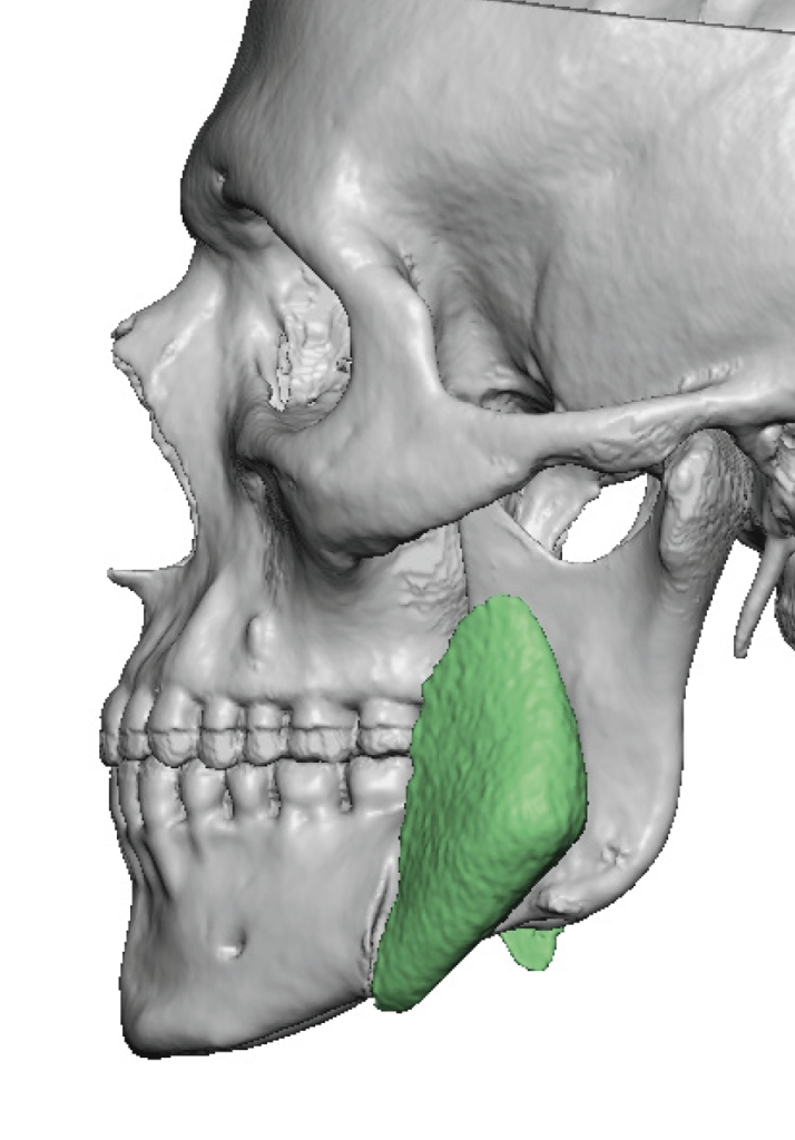 Plastic Surgery Case Study - Custom Jaw Angle Implant Replacements for ...