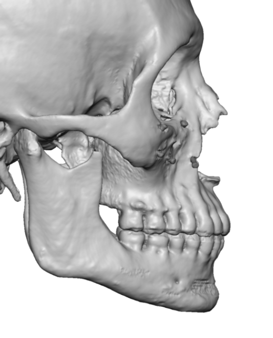 male vertically short jaw side view 3D CT scan Dr Barry Eppley ...