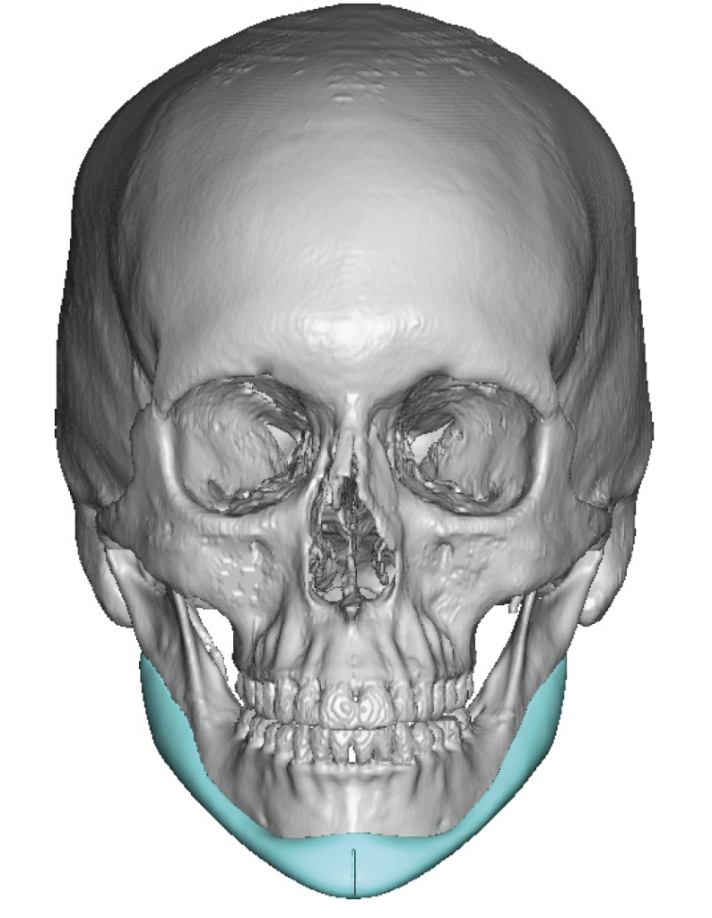 Plastic Surgery Case Study - Custom Jawline Implant for Female Subtotal ...