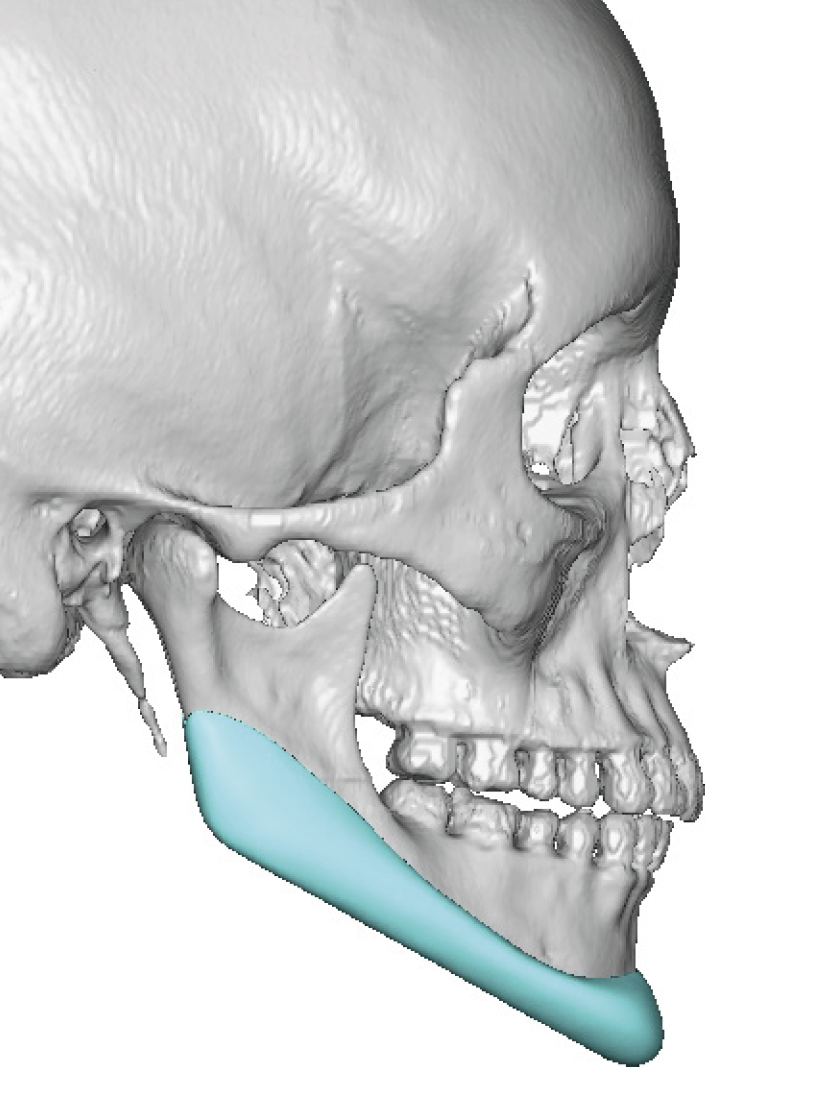 v line reversal custom jawline implant design side view Dr Barry Eppley ...