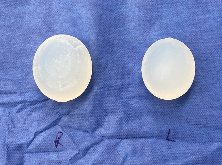 Custom Asymmetric Testicle Implants Dr Barry Eppley Explore Plastic Surgery 