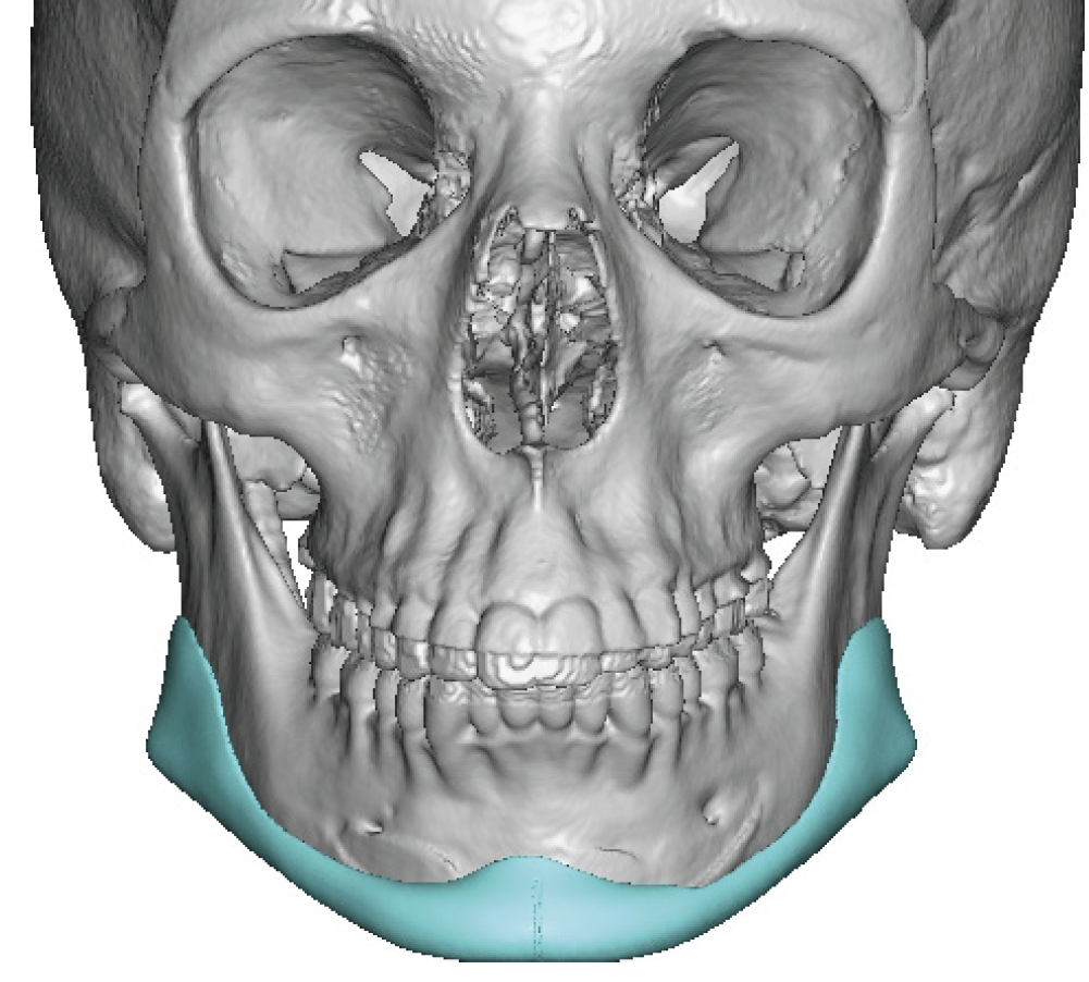 Plastic Surgery Case Study - Female Custom Jawline Implant Replacement ...