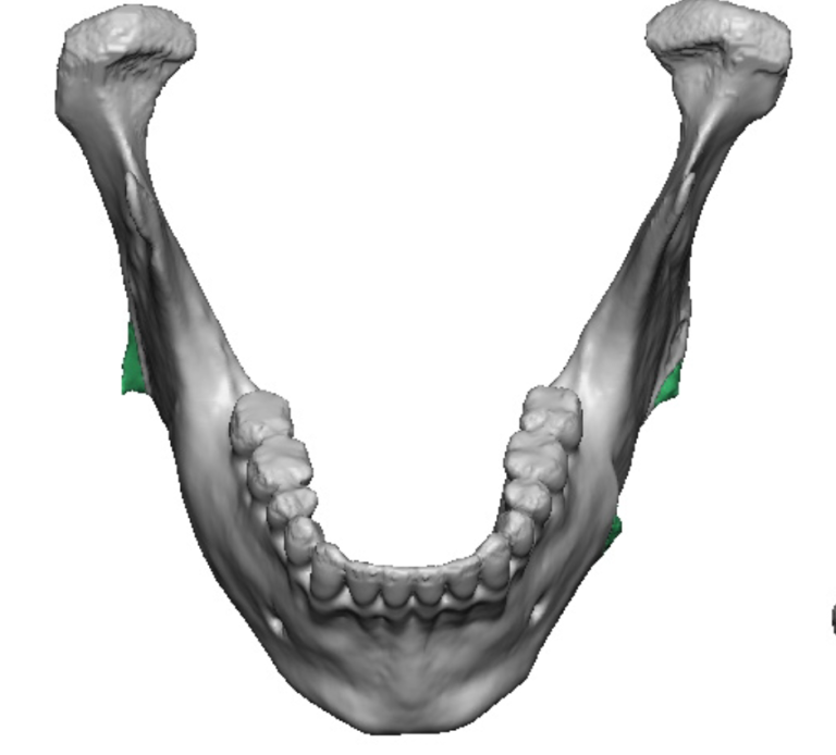 jaw angle implant overgrowth top view Dr Barry Eppley - Explore Plastic ...