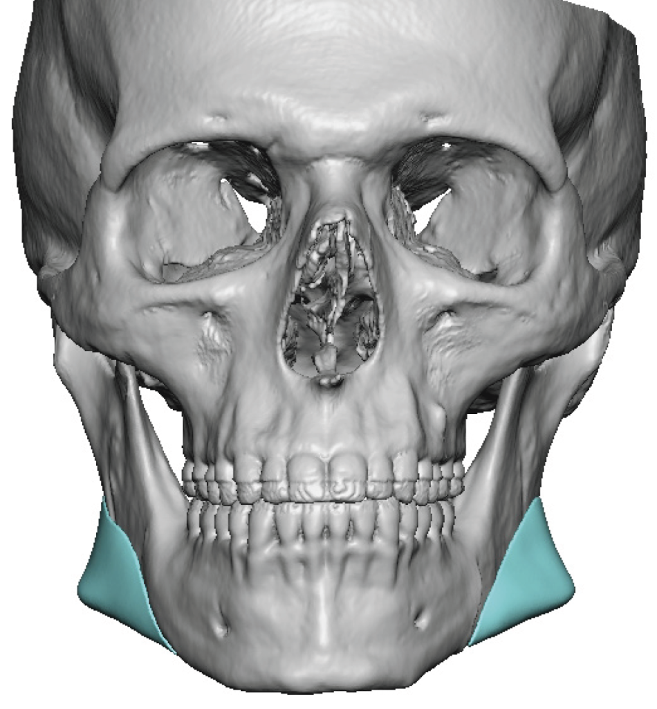 Plastic Surgery Case Study - Custom Jaw Angle Implant Replacements for ...