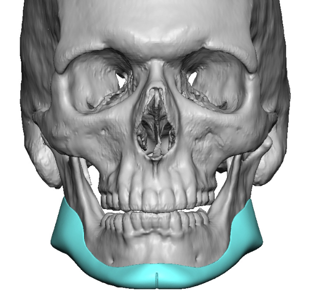 male custom.jawline implant design front view Dr Barry Eppley - Explore ...