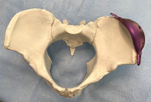 35mm iliac crest plate in position front view Dr Barry Eppley - Explore ...