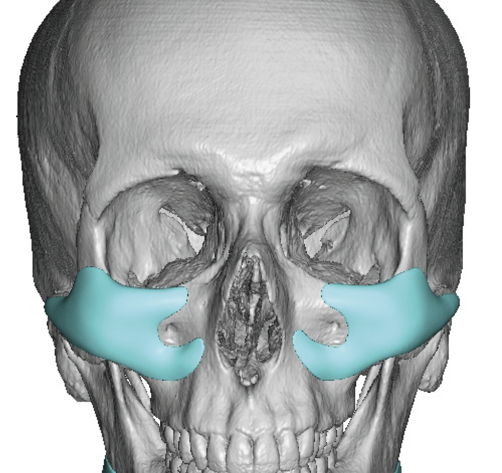 custom infraorbital-malar-maxilary implant design front view Dr Barry ...