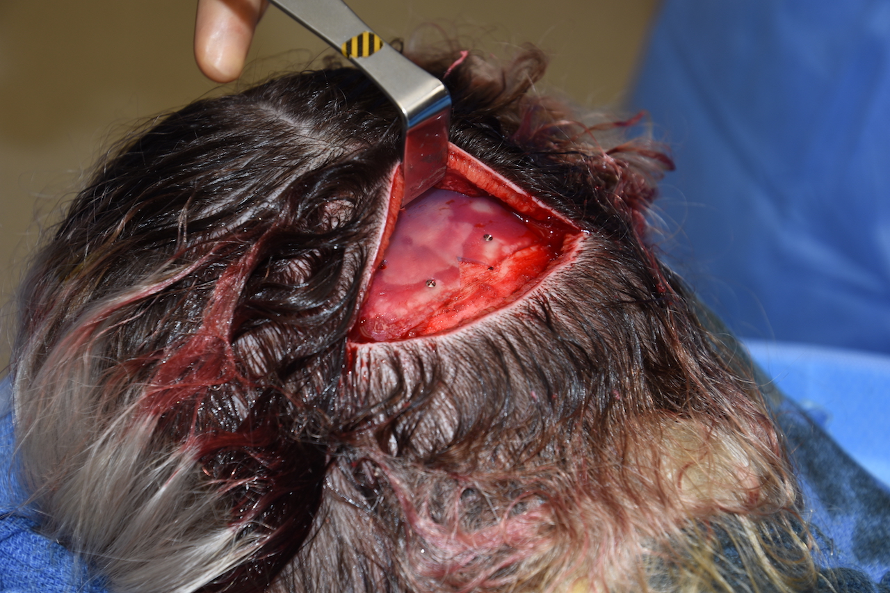 Postoperative 3d Ct Scanning For Custom Skull Implant Placement 