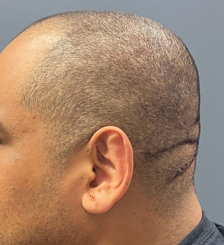 Male Custom Skull Implant With Scalp Roll Excision Side 2a Dr Barry 