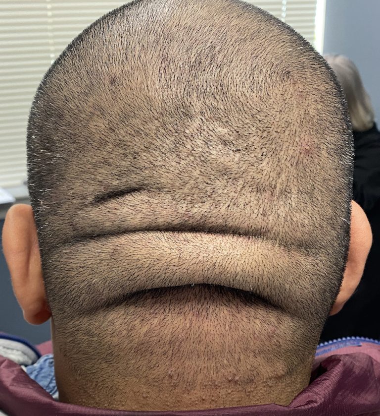 Male With Large Occipital Scalp Roll Back View Dr Barry Eppley 